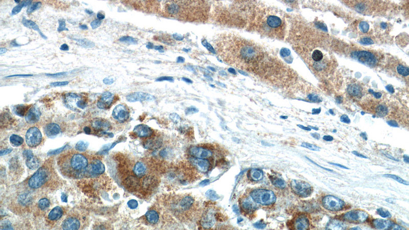 Immunohistochemistry of paraffin-embedded human liver cancer tissue slide using Catalog No:110003(DMGDH Antibody) at dilution of 1:200 (under 40x lens)