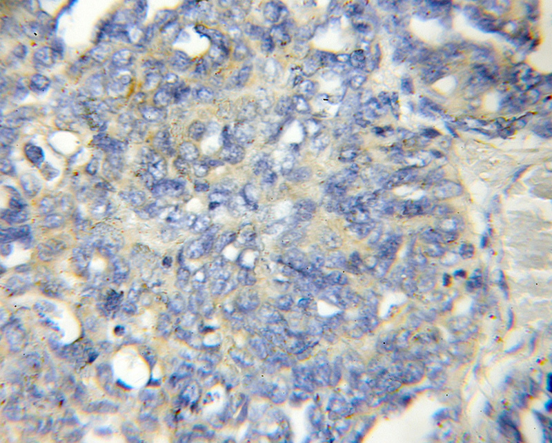 Immunohistochemical of paraffin-embedded human ovary tumor using Catalog No:112193(LENG1 antibody) at dilution of 1:50 (under 10x lens)