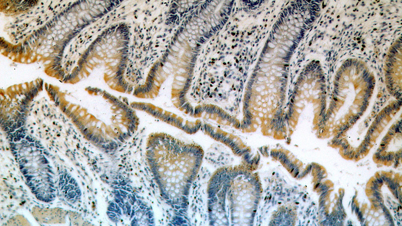 Immunohistochemical of paraffin-embedded human colon using Catalog No:114780(RocK2-Specific antibody) at dilution of 1:100 (under 10x lens)