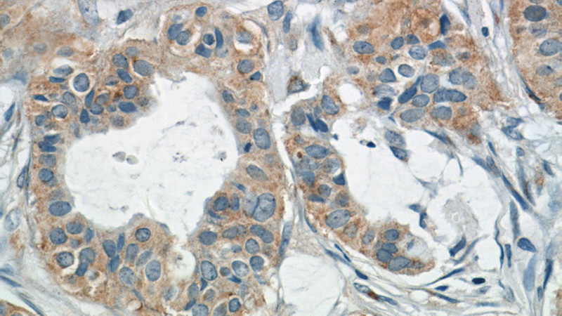 Immunohistochemistry of paraffin-embedded human breast cancer tissue slide using Catalog No:116067(TK1 Antibody) at dilution of 1:50 (under 40x lens)