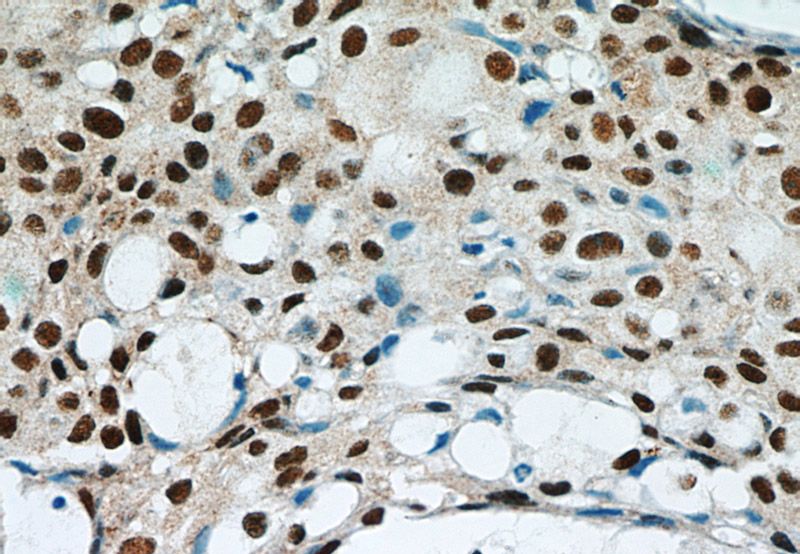 Immunohistochemical of paraffin-embedded human breast cancer using Catalog No:110804(GABPA antibody) at dilution of 1:50 (under 40x lens)