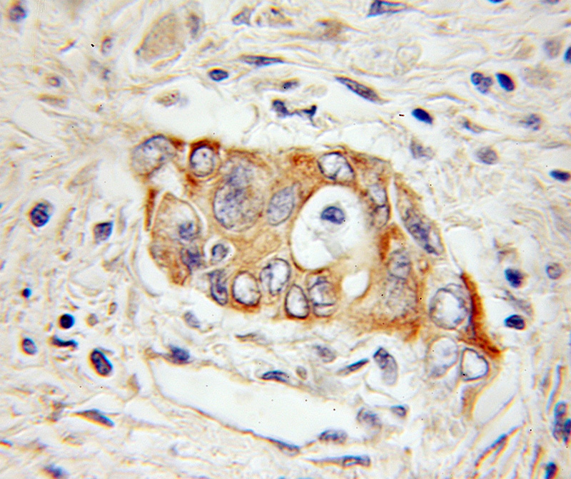 Immunohistochemical of paraffin-embedded human pancreas cancer using Catalog No:111292(HEPH antibody) at dilution of 1:50 (under 10x lens)
