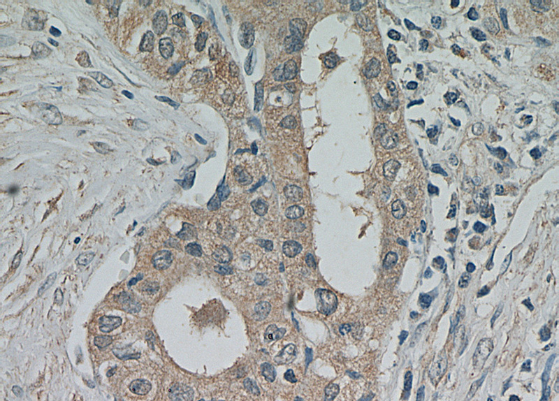 Immunohistochemical of paraffin-embedded human thyroid cancer using Catalog No:113850(PRKCE antibody) at dilution of 1:100 (under 40x lens)