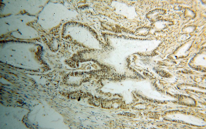 Immunohistochemical of paraffin-embedded human colon cancer using Catalog No:111506(HNRNPF antibody) at dilution of 1:50 (under 10x lens)