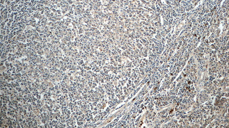 Immunohistochemistry of paraffin-embedded human tonsillitis tissue slide using Catalog No:107388(IL1F8 Antibody) at dilution of 1:50 (under 10x lens)