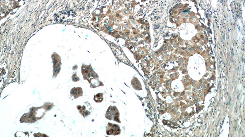 Immunohistochemistry of paraffin-embedded human breast cancer tissue slide using Catalog No:109599(CSN3 Antibody) at dilution of 1:25 (under 10x lens)