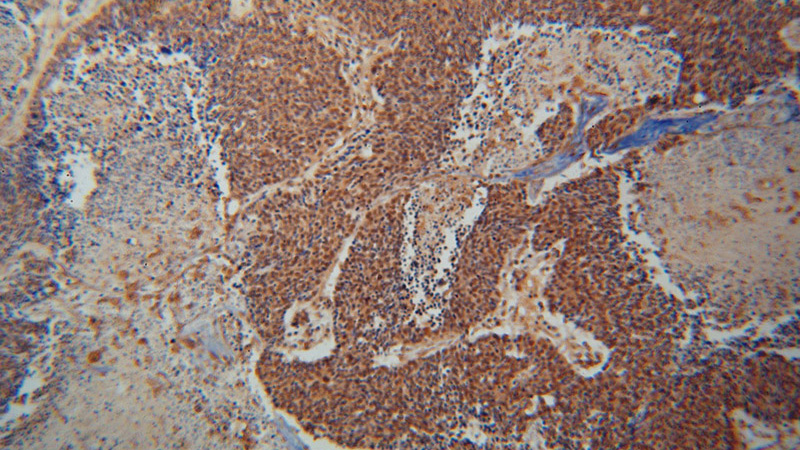 Immunohistochemical of paraffin-embedded human lung cancer using Catalog No:115121(SEPT7 antibody) at dilution of 1:100 (under 10x lens)