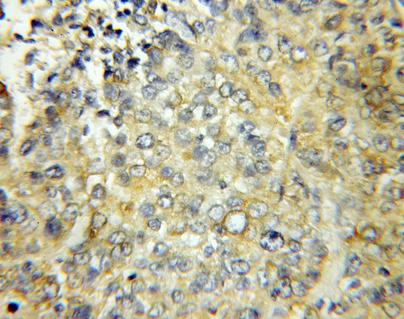 Immunohistochemical of paraffin-embedded human lung cancer using Catalog No:110870(GAS2 antibody) at dilution of 1:50 (under 10x lens)