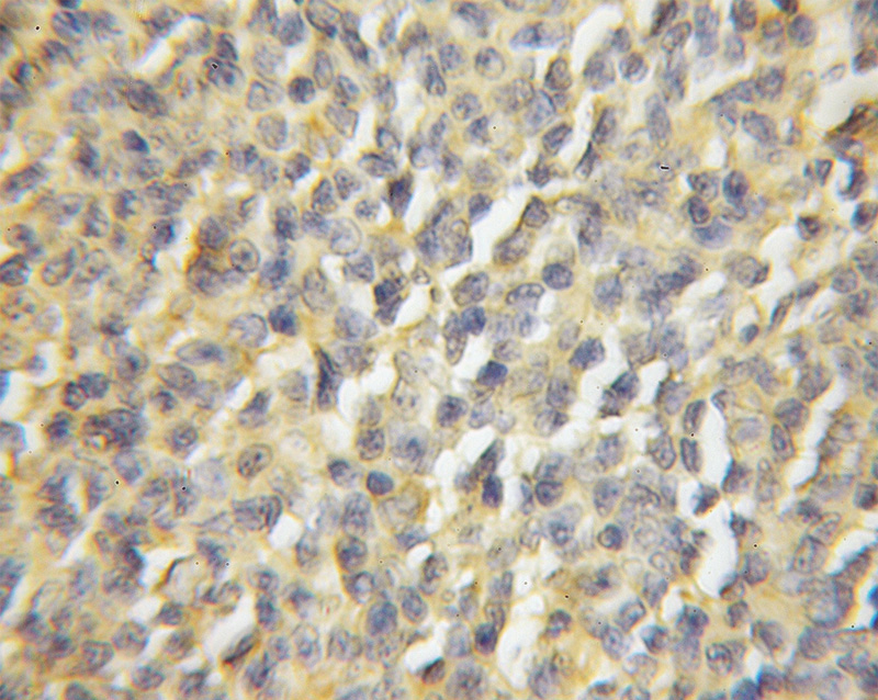 Immunohistochemical of paraffin-embedded human lymphoma using Catalog No:116386(TTC4 antibody) at dilution of 1:50 (under 10x lens)