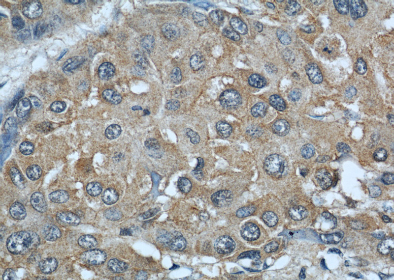 Immunohistochemical of paraffin-embedded human liver cancer using Catalog No:107856(AIP antibody) at dilution of 1:50 (under 40x lens)