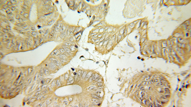Immunohistochemical of paraffin-embedded human colon cancer using Catalog No:115323(SLC25A13 antibody) at dilution of 1:100 (under 10x lens)