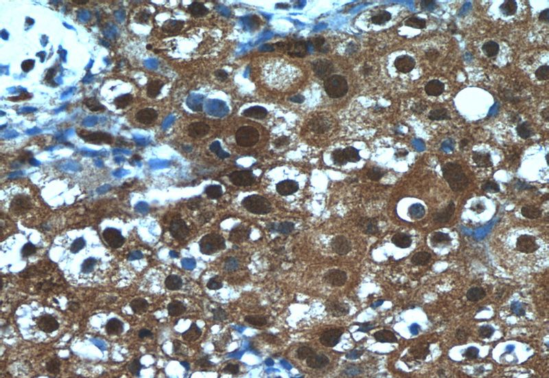 Immunohistochemistry of paraffin-embedded human breast cancer tissue slide using Catalog No:108086(ANKS3 Antibody) at dilution of 1:50 (under 40x lens)