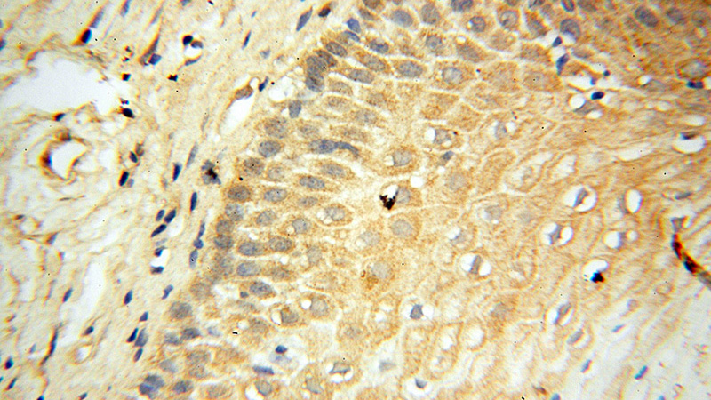 Immunohistochemical of paraffin-embedded human cervix using Catalog No:114976(SAT2 antibody) at dilution of 1:50 (under 40x lens)