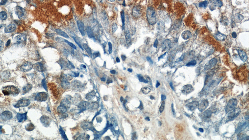 Immunohistochemistry of paraffin-embedded human breast cancer tissue slide using Catalog No:110396(EPSTI1 Antibody) at dilution of 1:50 (under 40x lens)