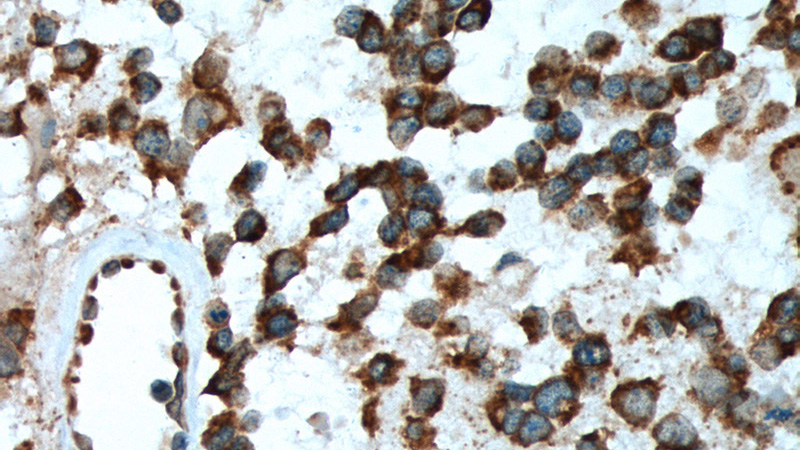 Immunohistochemistry of paraffin-embedded human gliomas tissue slide using (Nestin Antibody) at dilution of 1:200 (under 40x lens).