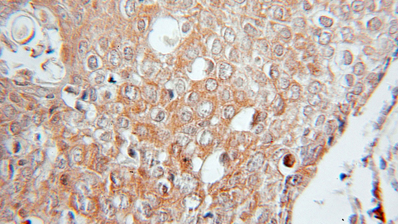 Immunohistochemical of paraffin-embedded human lung cancer using Catalog No:111737(IL32 antibody) at dilution of 1:50 (under 10x lens)