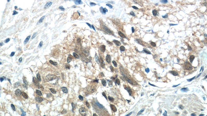 Immunohistochemistry of paraffin-embedded human colon tissue slide using Catalog No:109397(CLN6 Antibody) at dilution of 1:50 (under 40x lens)