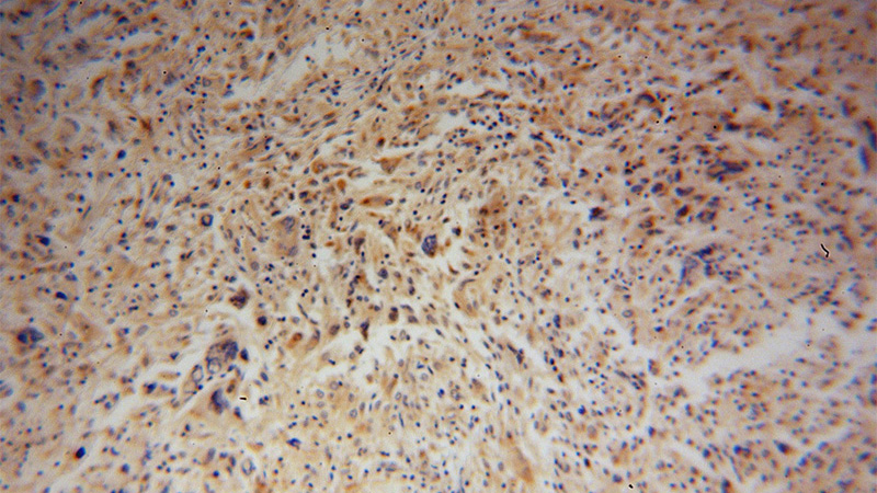 Immunohistochemical of paraffin-embedded human gliomas using Catalog No:112014(KIF3C antibody) at dilution of 1:100 (under 10x lens)