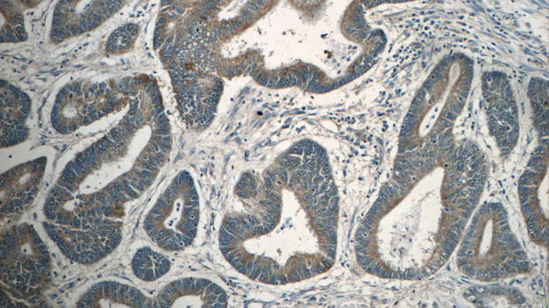 Immunohistochemistry of paraffin-embedded human colon cancer tissue slide using Catalog No:112614(MDK Antibody) at dilution of 1:50 (under 10x lens)