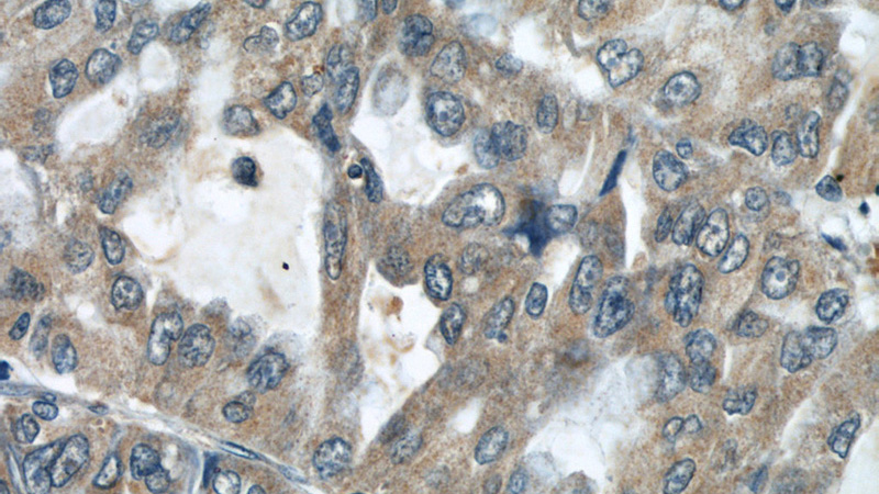 Immunohistochemistry of paraffin-embedded human lung cancer slide using Catalog No:107675(AARS2 Antibody) at dilution of 1:50