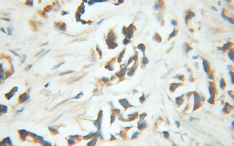 Immunohistochemical of paraffin-embedded human prostate cancer using Catalog No:113973(PNKD antibody) at dilution of 1:100 (under 10x lens)