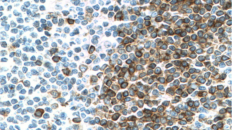 Immunohistochemistry of paraffin-embedded human tonsillitis tissue slide using Catalog No:109138(CD79A Antibody) at dilution of 1:200 (under 40x lens)