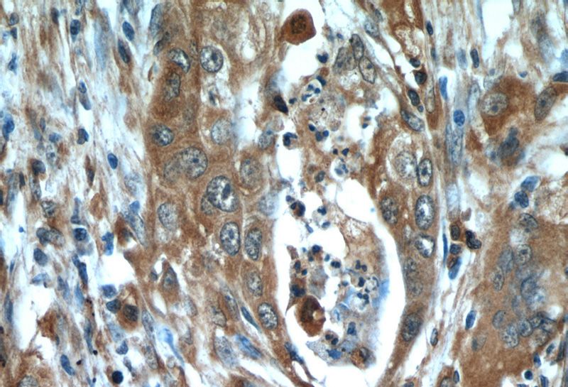 Immunohistochemical of paraffin-embedded human lung cancer using Catalog No:109814(KRT8 antibody) at dilution of 1:50 (under 40x lens)