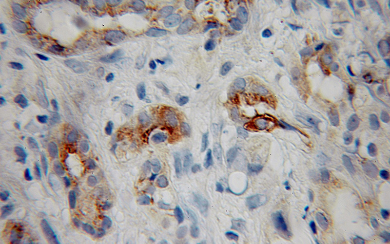 Immunohistochemical of paraffin-embedded human pancreas cancer using Catalog No:112707(MMP7 antibody) at dilution of 1:100 (under 10x lens)