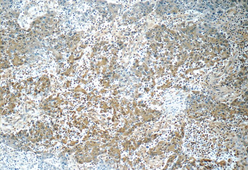 Immunohistochemistry of paraffin-embedded human colon cancer tissue slide using Catalog No:113419(Orail-L2 Antibody) at dilution of 1:50 (under 10x lens)