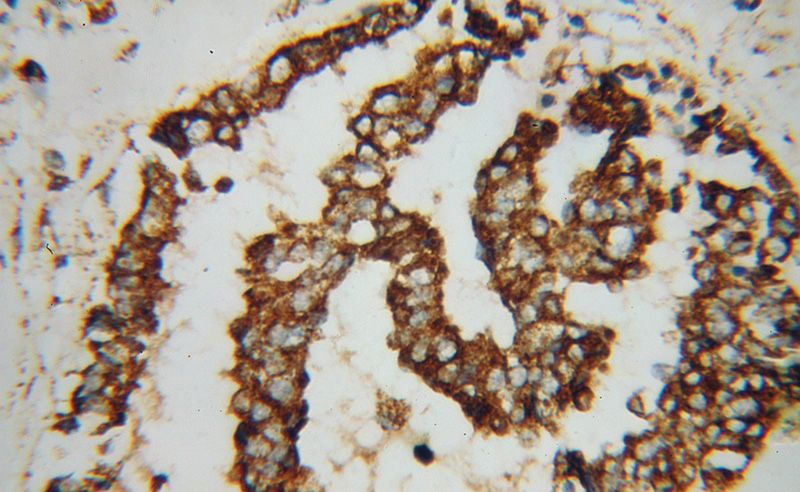 Immunohistochemical of paraffin-embedded human breast cancer using Catalog No:111220(GRP75 antibody) at dilution of 1:100 (under 40x lens)