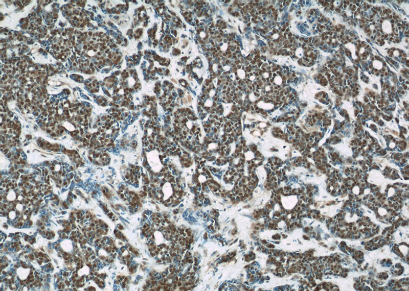 Immunohistochemical of paraffin-embedded human cervical cancer using Catalog No:107497(RBBP4 antibody) at dilution of 1:200 (under 10x lens)