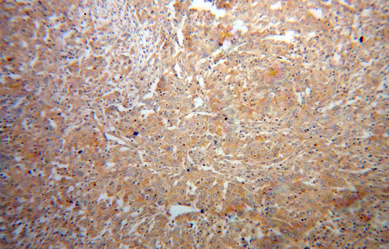 Immunohistochemical of paraffin-embedded human breast cancer using Catalog No:113560(p70(S6K) antibody) at dilution of 1:100 (under 10x lens)