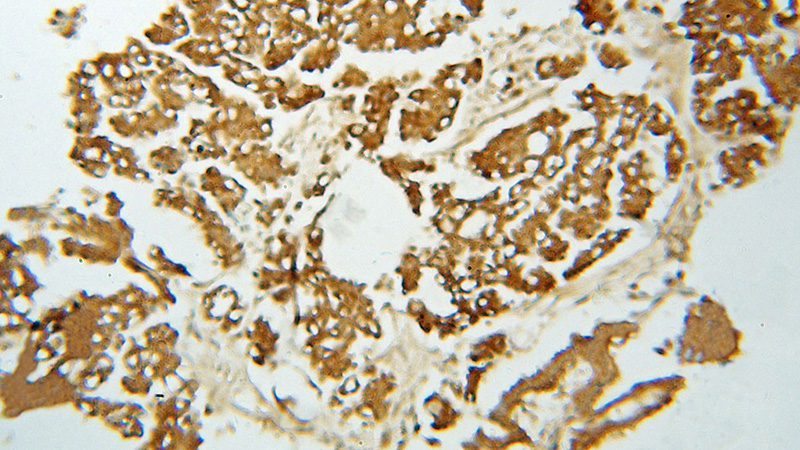 Immunohistochemical of paraffin-embedded human ovary tumor using Catalog No:108843(CAPZA1 antibody) at dilution of 1:50 (under 10x lens)
