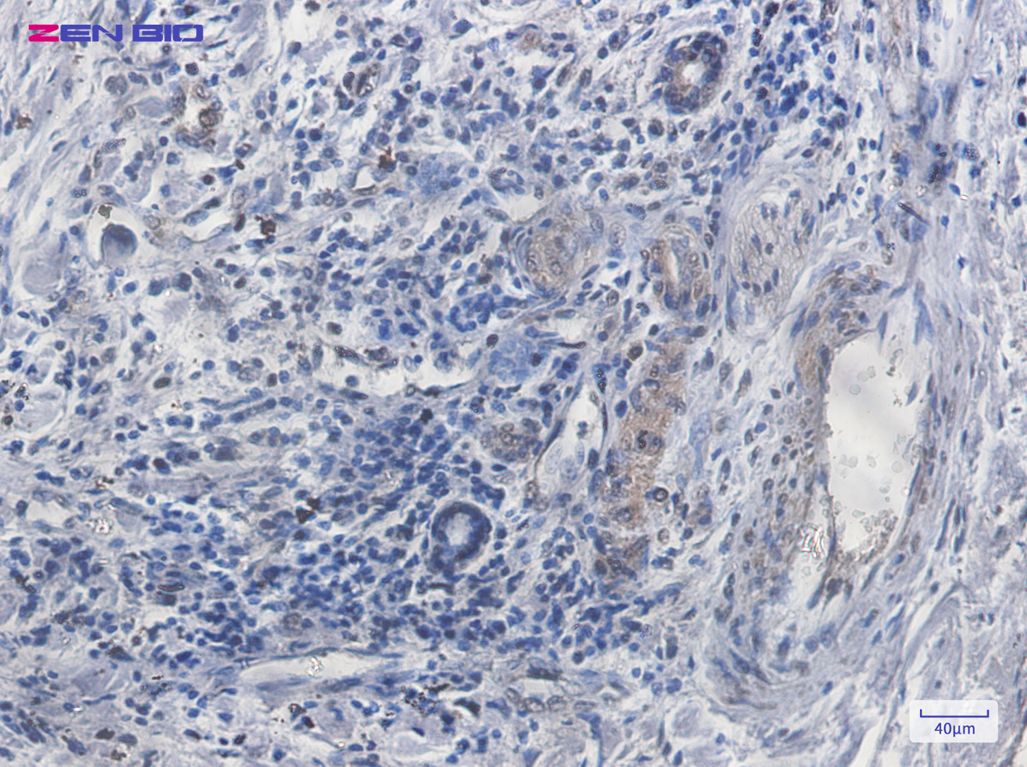 Immunohistochemistry of SCAI in paraffin-embedded Human lung cancer tissue using SCAI Rabbit pAb at dilution 1/20