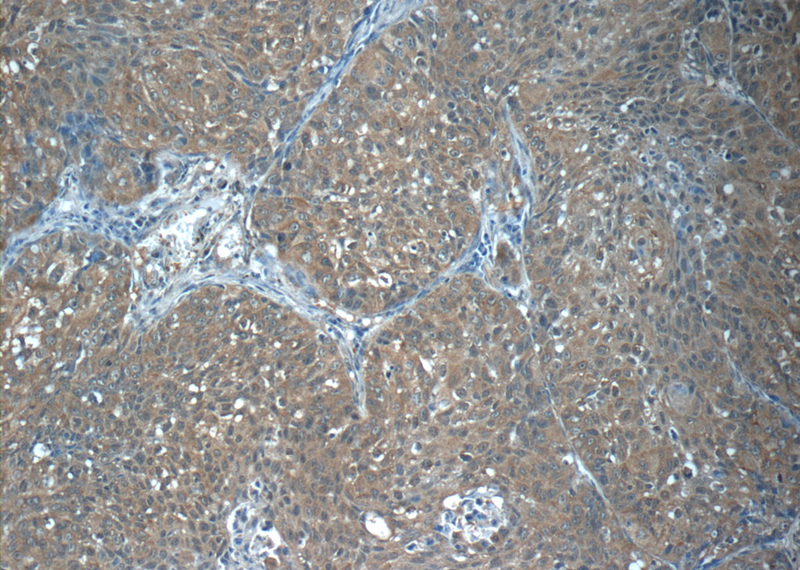 Immunohistochemistry of paraffin-embedded human lung cancer tissue slide using Catalog No:114285(PRX3 Antibody) at dilution of 1:50 (under 10x lens)