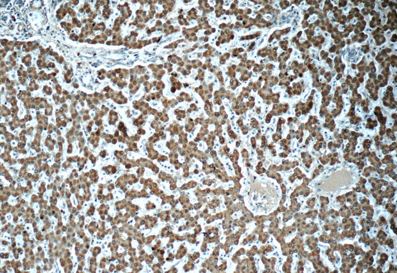 Immunohistochemistry of paraffin-embedded human liver tissue slide using Catalog No:107792(ADHFE1 Antibody) at dilution of 1:50(under 10x lens)