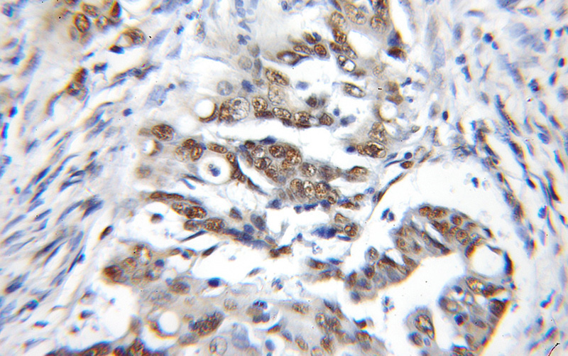 Immunohistochemical of paraffin-embedded human colon cancer using Catalog No:108945(CBX3 antibody) at dilution of 1:100 (under 10x lens)