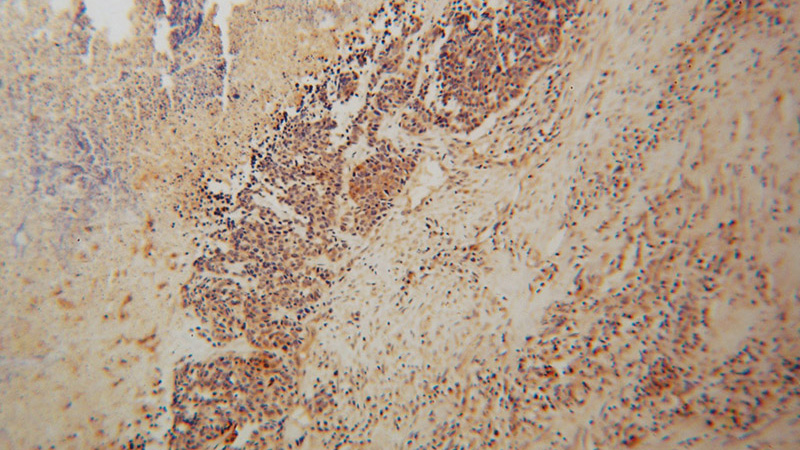 Immunohistochemical of paraffin-embedded human lung cancer using Catalog No:113062(NDUFA6 antibody) at dilution of 1:100 (under 10x lens)
