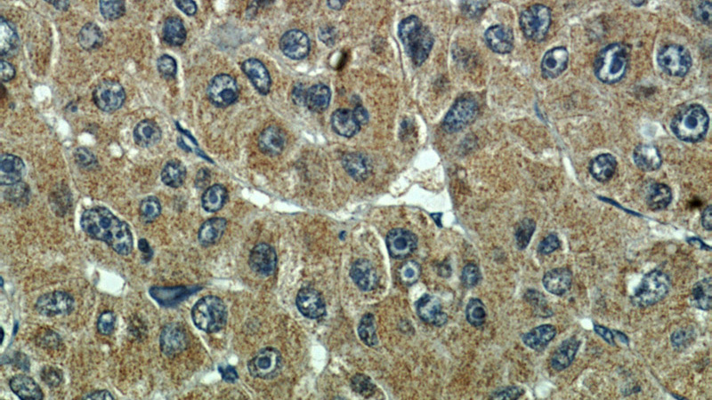 Immunohistochemical of paraffin-embedded human liver cancer using Catalog No:117299(Tubulin-Alpha antibody) at dilution of 1:100 (under 40x lens)