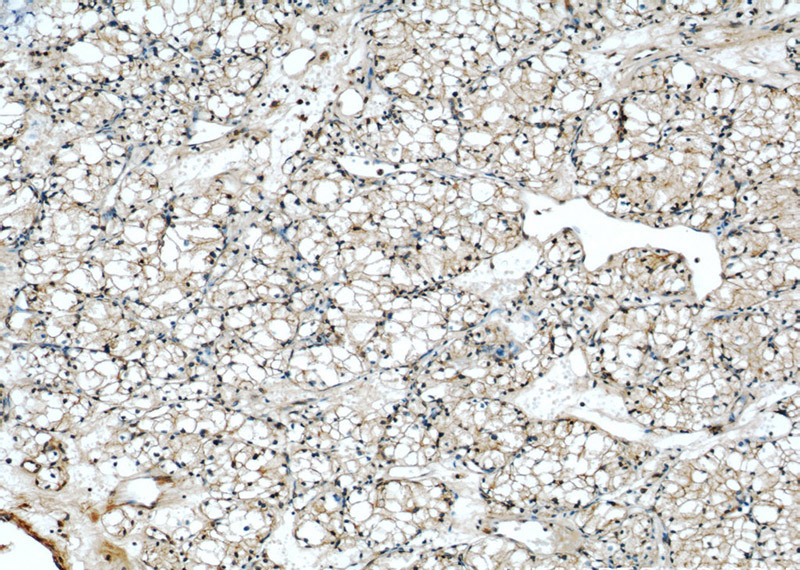 Immunohistochemical of paraffin-embedded human nephroblastoma using Catalog No:113310(NOV antibody) at dilution of 1:50 (under 10x lens)