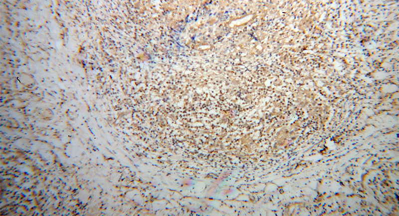 Immunohistochemical of paraffin-embedded human breast cancer using Catalog No:114713(RIOK3 antibody) at dilution of 1:100 (under 10x lens)