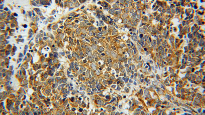 Immunohistochemical of paraffin-embedded human lung cancer using Catalog No:112938(Myh9 antibody) at dilution of 1:50 (under 40x lens)