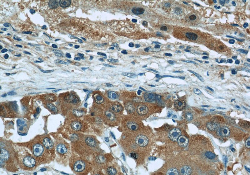 Immunohistochemical of paraffin-embedded human liver cancer using Catalog No:107206(AHSG antibody) at dilution of 1:200 (under 40x lens)