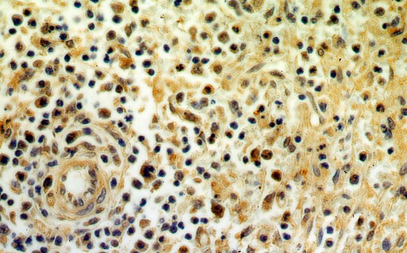 Immunohistochemical of paraffin-embedded human spleen using Catalog No:115695(STAT6 antibody) at dilution of 1:50 (under 40x lens)
