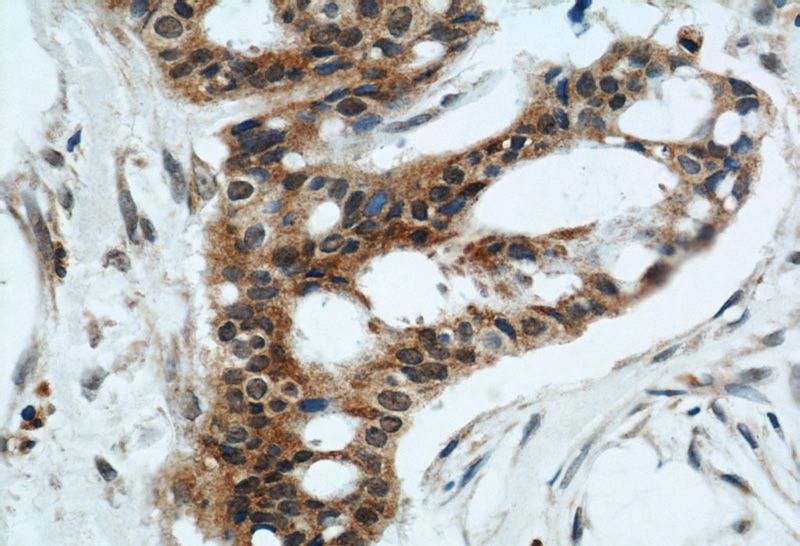 Immunohistochemical of paraffin-embedded human breast cancer using Catalog No:110704(FOXO3A antibody) at dilution of 1:50 (under 40x lens)