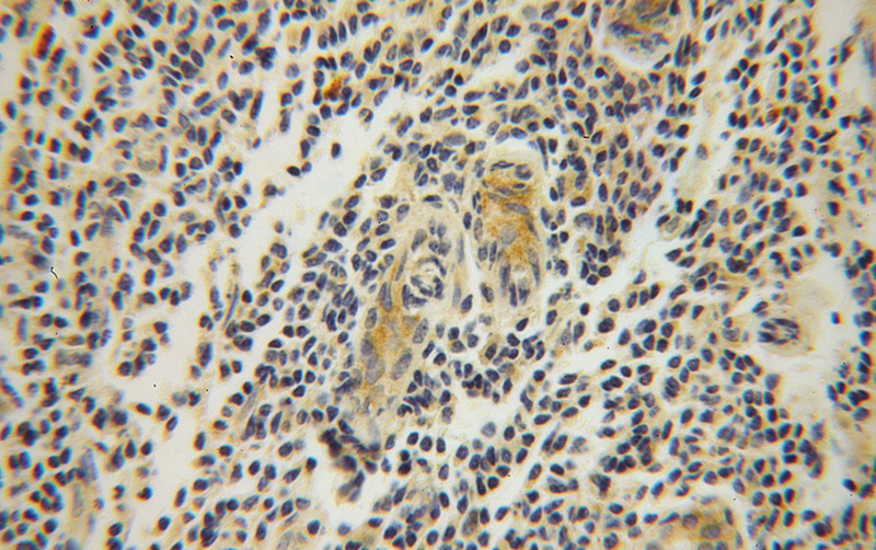 Immunohistochemical of paraffin-embedded human breast cancer using Catalog No:114893(RPL37A antibody) at dilution of 1:100 (under 40x lens)
