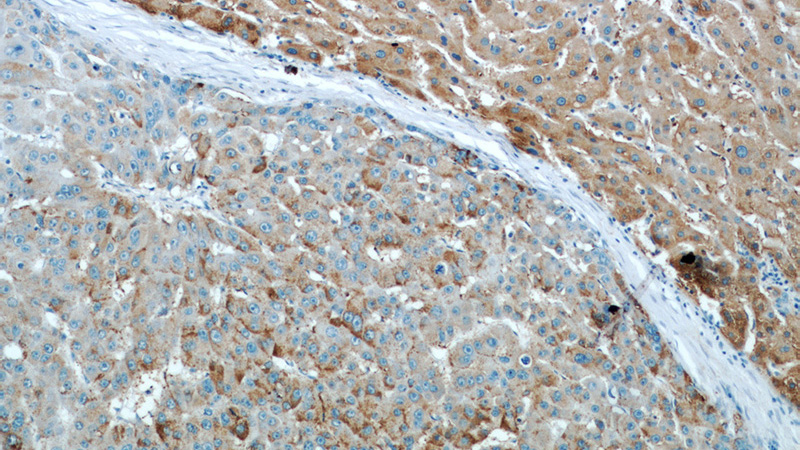 Immunohistochemical of paraffin-embedded human liver cancer using Catalog No:116827(Willin antibody) at dilution of 1:50 (under 10x lens)