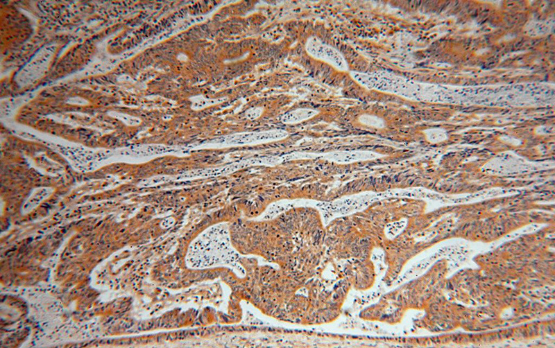 Immunohistochemical of paraffin-embedded human colon cancer using Catalog No:110268(EIF5A2 antibody) at dilution of 1:100 (under 10x lens)