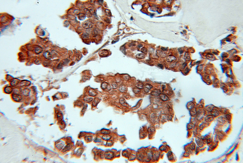Immunohistochemical of paraffin-embedded human breast cancer using Catalog No:115835(SUMF2 antibody) at dilution of 1:50 (under 10x lens)