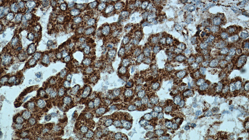 Immunohistochemical of paraffin-embedded human ovary tumor using Catalog No:111865(ITGB6 antibody) at dilution of 1:50 (under 40x lens)